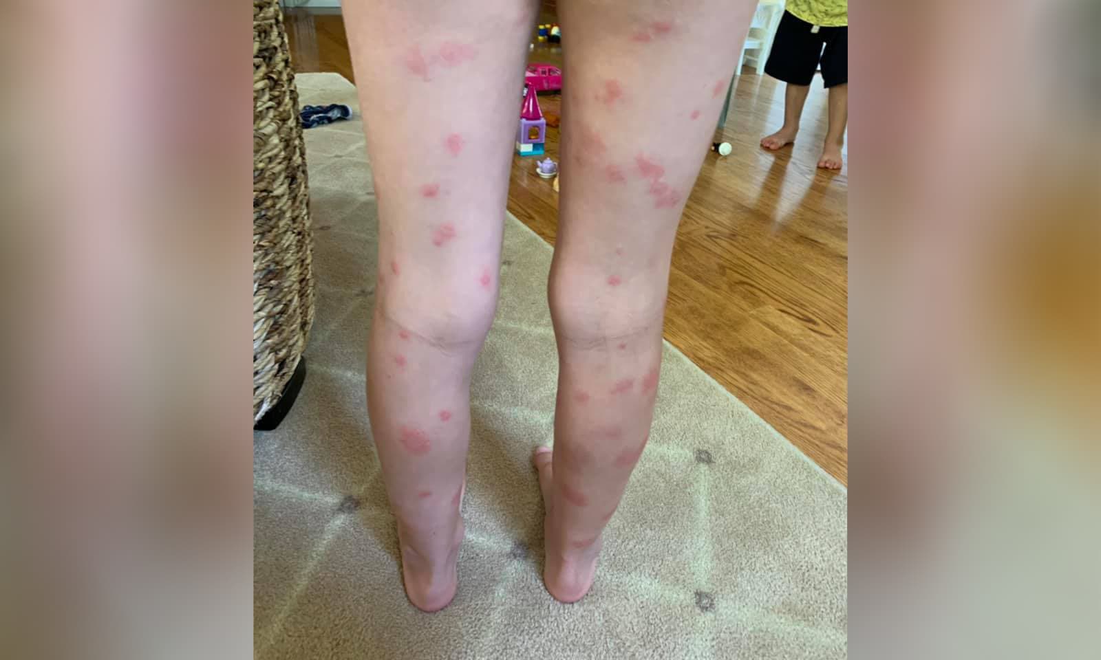 At least a dozen children develop swimmers itch from Bangs Lake